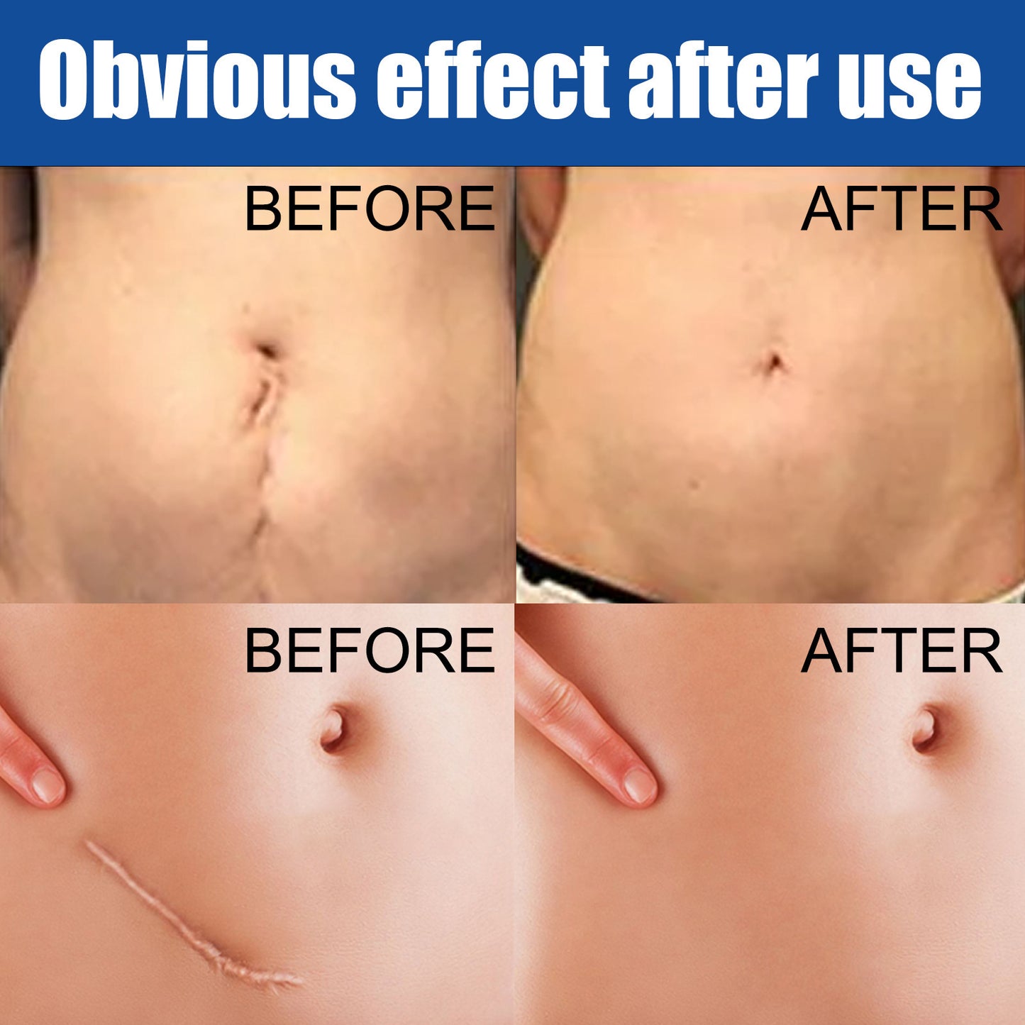 Care Reduces Scars Repairing Cream Acne Marks