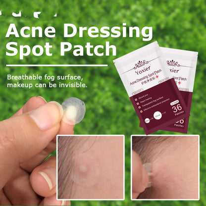 Acne  Blemish Treatment