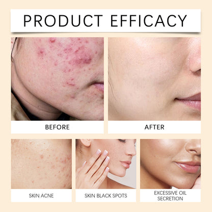 Acne Mark And Moisturize Face Cream