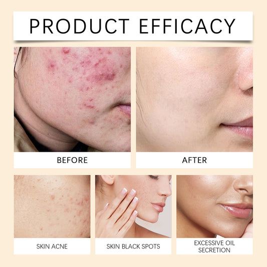 Acne Mark And Moisturize Face Cream