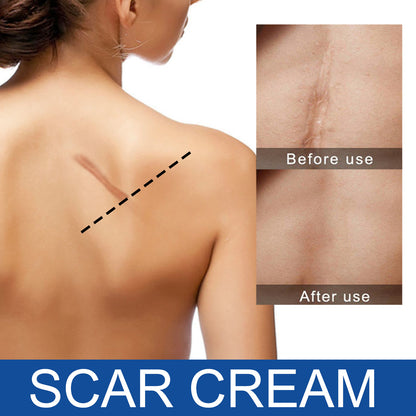 Care Reduces Scars Repairing Cream Acne Marks