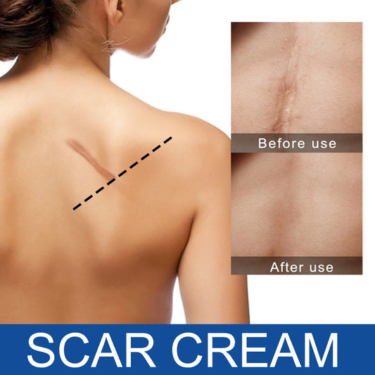 Care Reduces Scars Repairing Cream Acne Marks