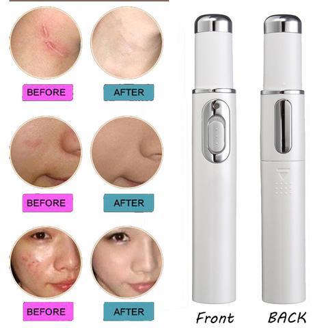 Scar Wrinkle Removal Treatment
