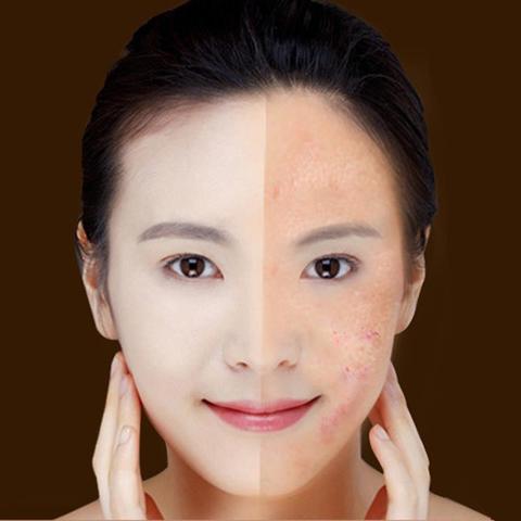 Scar Wrinkle Removal Treatment