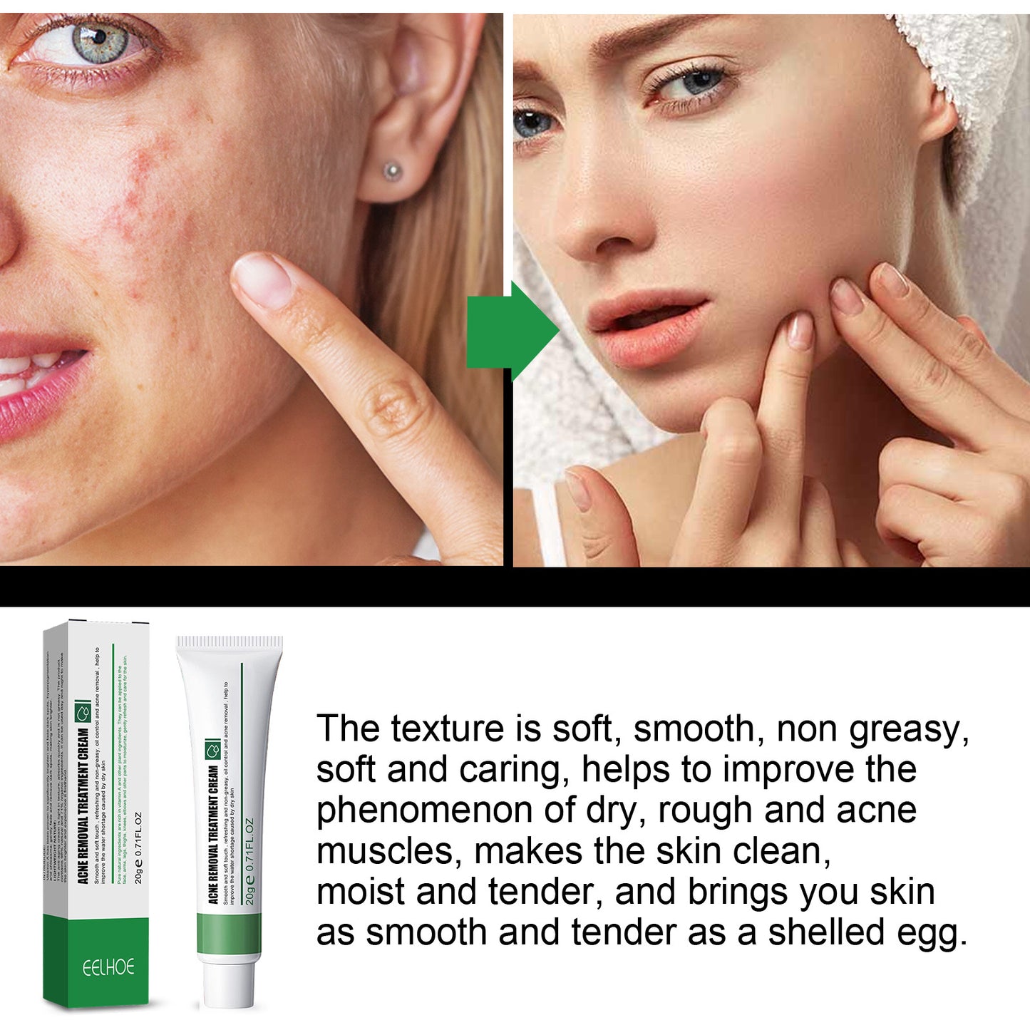 EELHOE Acne & Blemish Cream Lightens