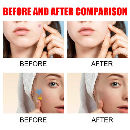 Hydrocolloid Acne Patches