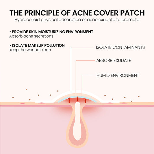 Hydrocolloid Acne Patches
