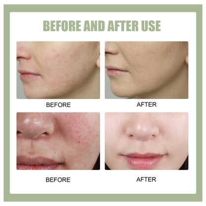 Blemish Gel Modifies Spot Acne Print Cover